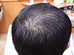 育毛　発毛　育毛サロン